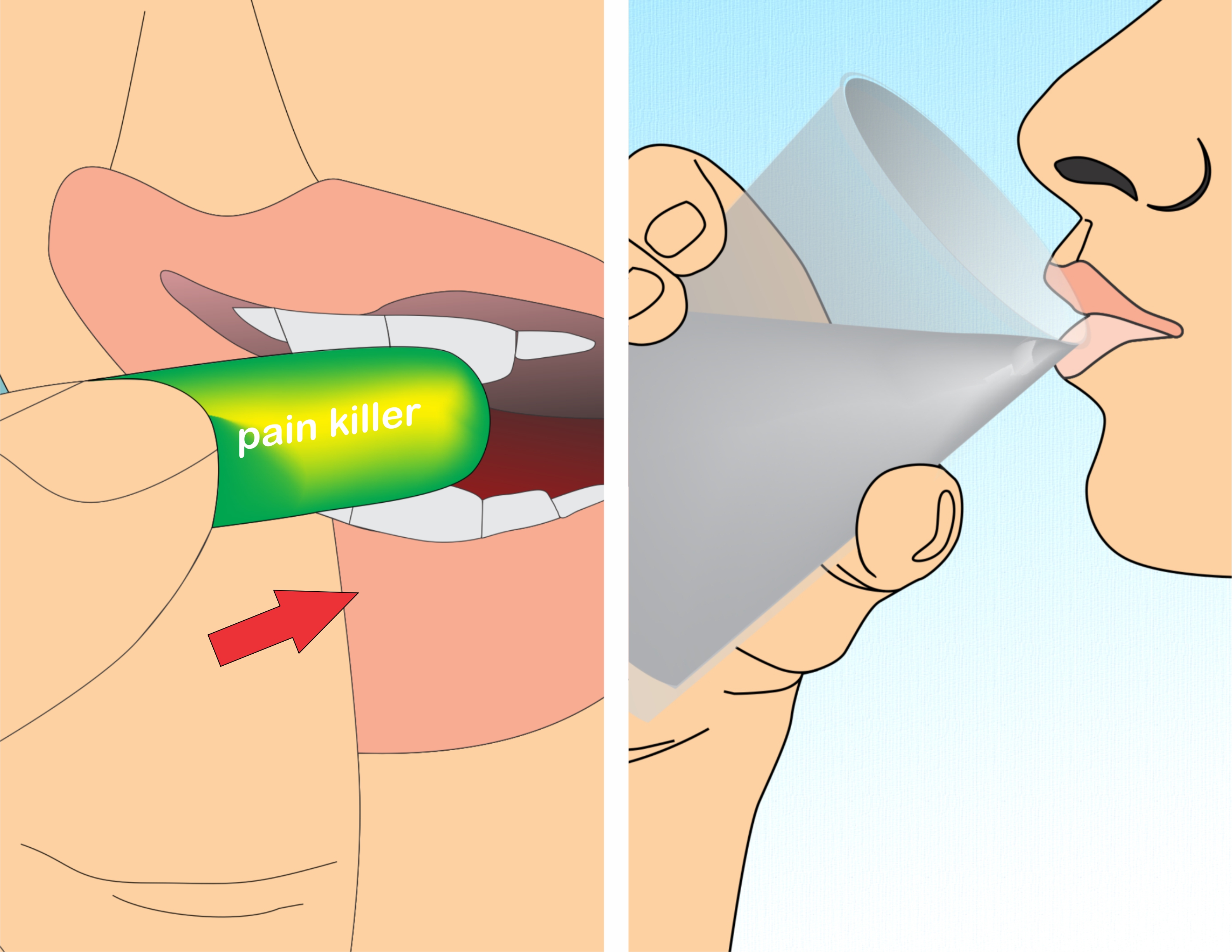 ingrown toenail diagram