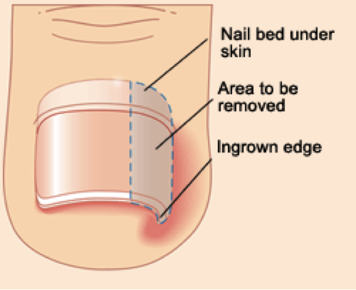 ingrown toenail diagram