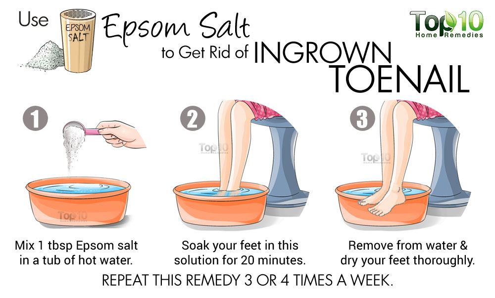 ingrown toenail diagram