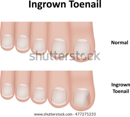 ingrown toenail diagram