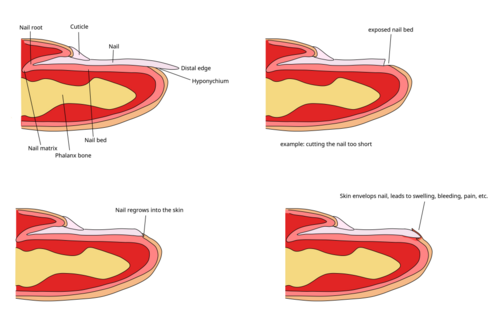 ingrown toenail diagram