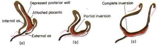 inverted uterus diagram