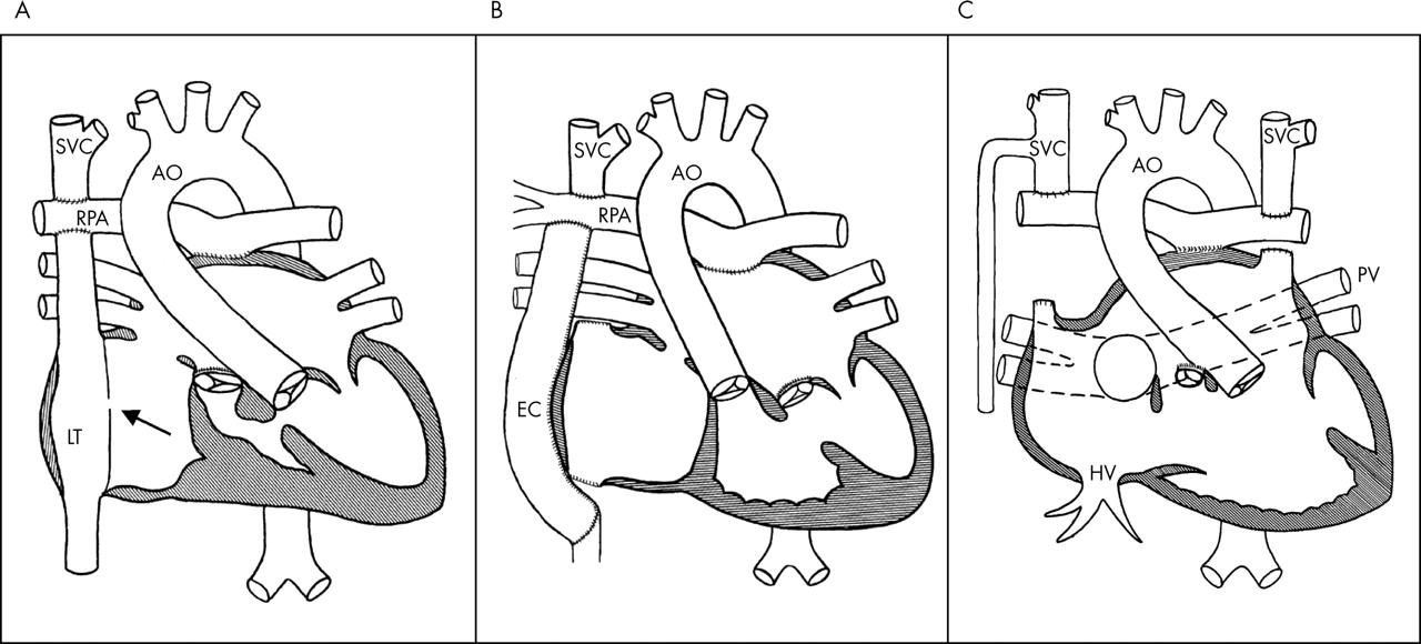 kawashima procedure diagram