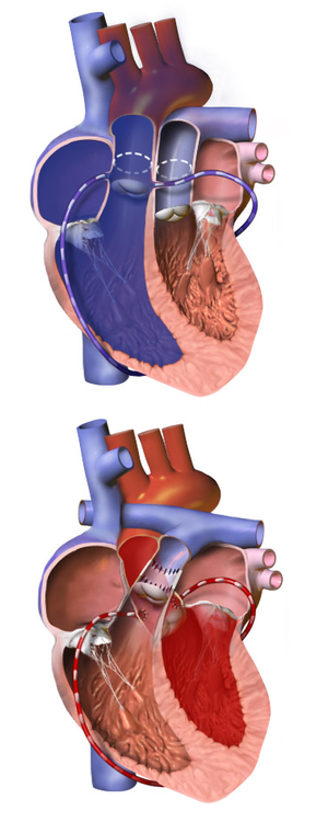 kawashima procedure diagram