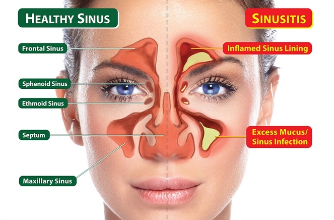 neti pot diagram of sinus