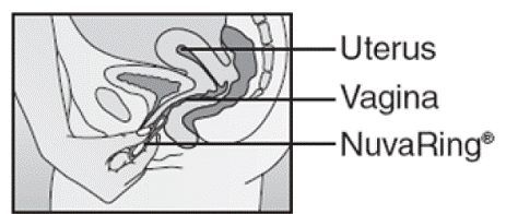 nuvaring diagram