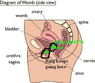 nuvaring diagram