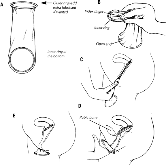 nuvaring insertion diagram