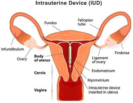 nuvaring insertion diagram