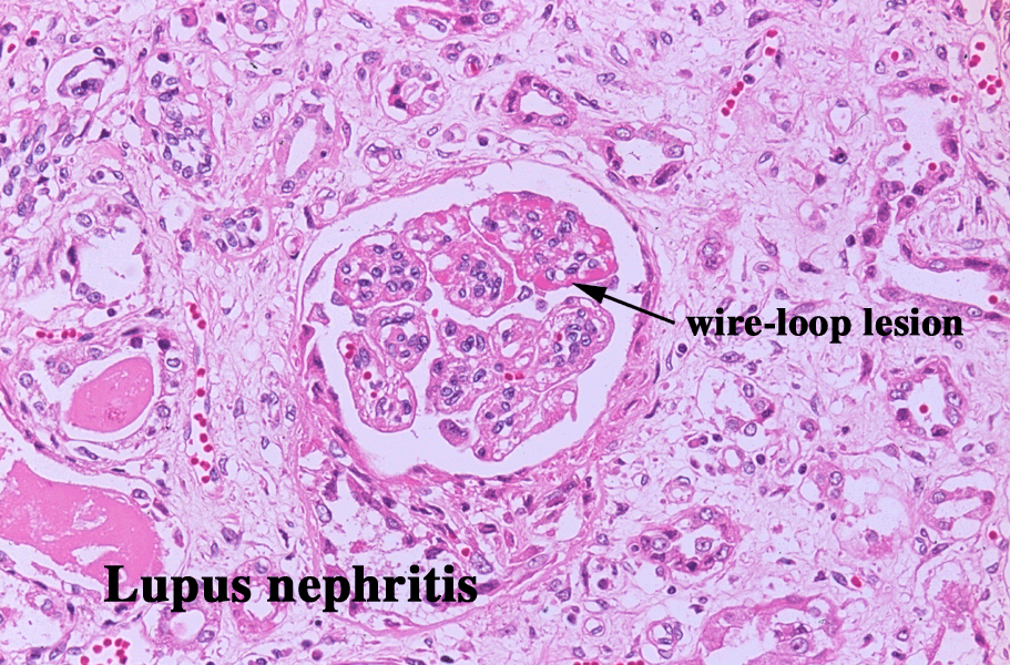 Люпус нефрит картинки