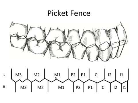 picket fence diagram for occlusion