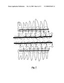 picket fence diagram for occlusion