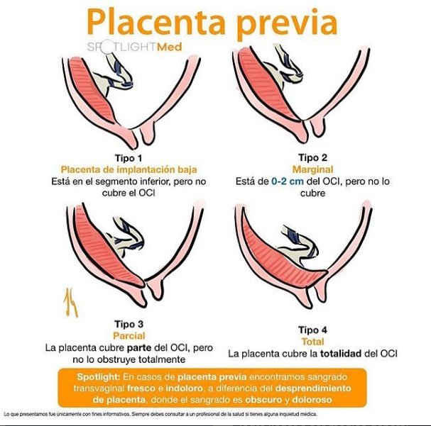 placenta previa diagram