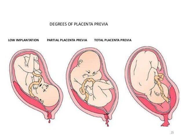 placenta previa diagram