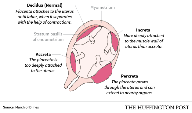 placenta previa diagram