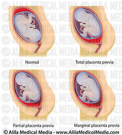 placenta previa diagram