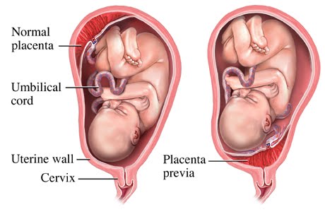 placenta previa diagram