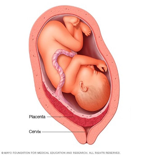 placenta previa diagram