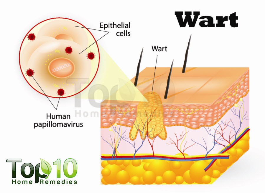 planters wart diagram