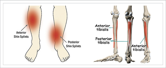 shin splints diagram