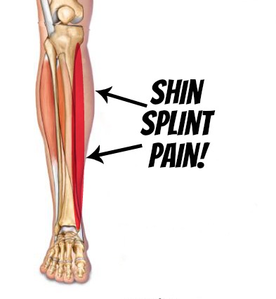shin splints pictures diagrams