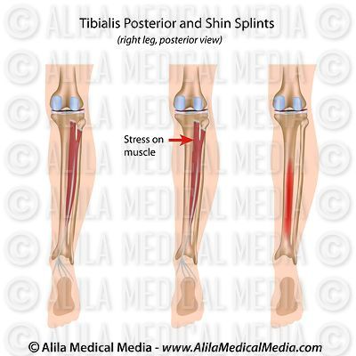 shin splints pictures diagrams