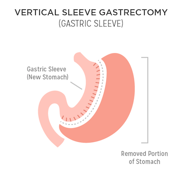sleeve gastrectomy diagram
