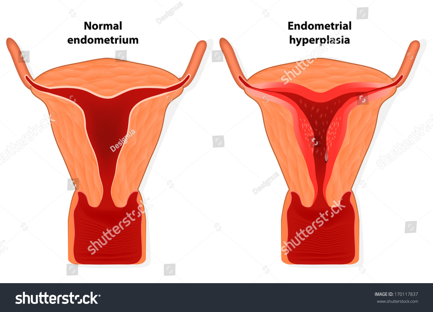tilted uterus diagram