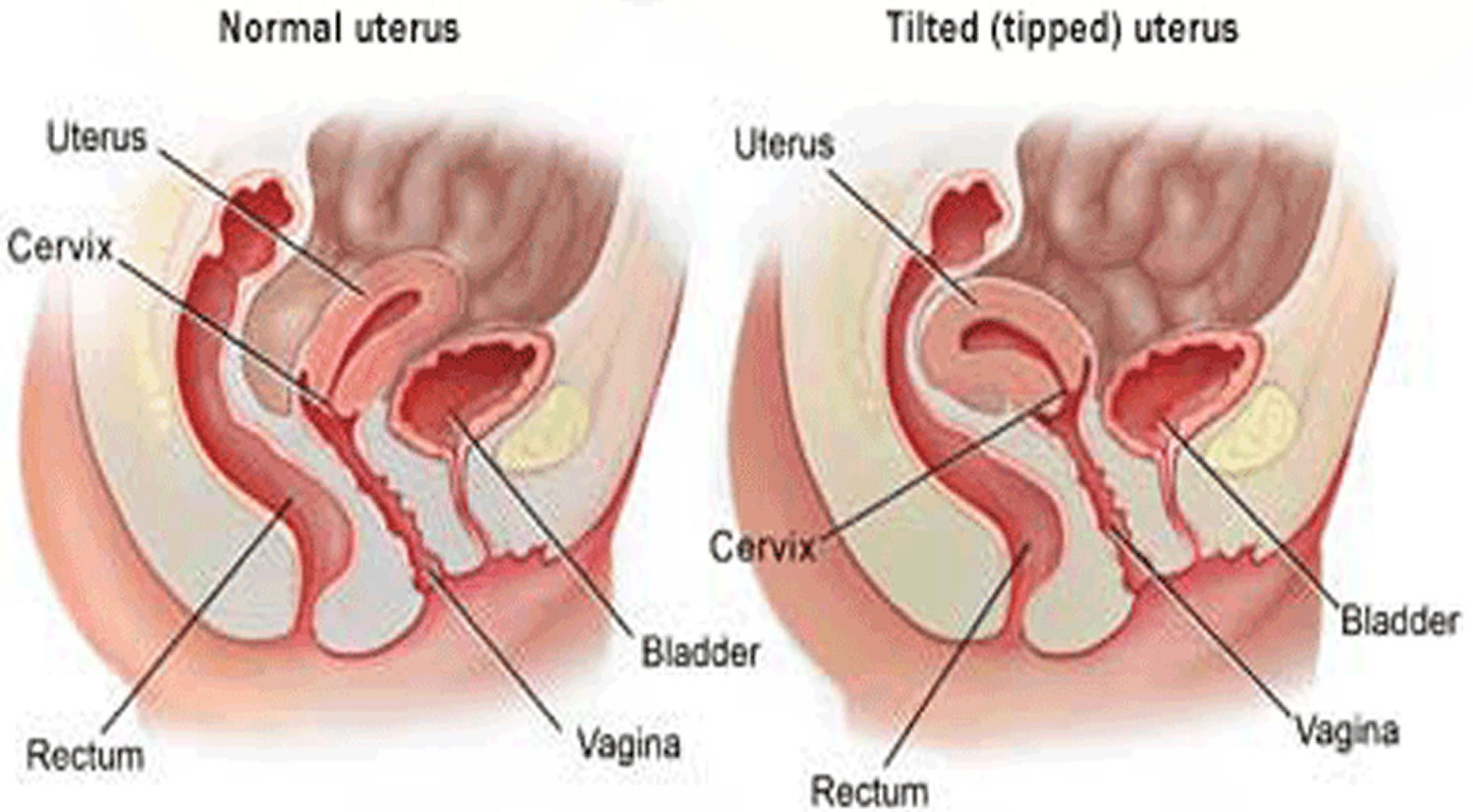 tilted uterus diagram