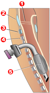 tracheostomy tube diagram