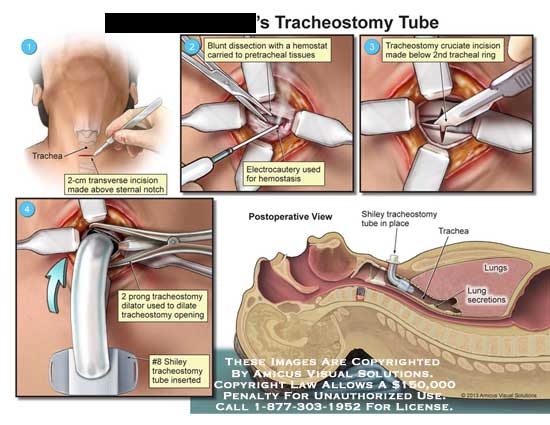 tracheostomy tube diagram