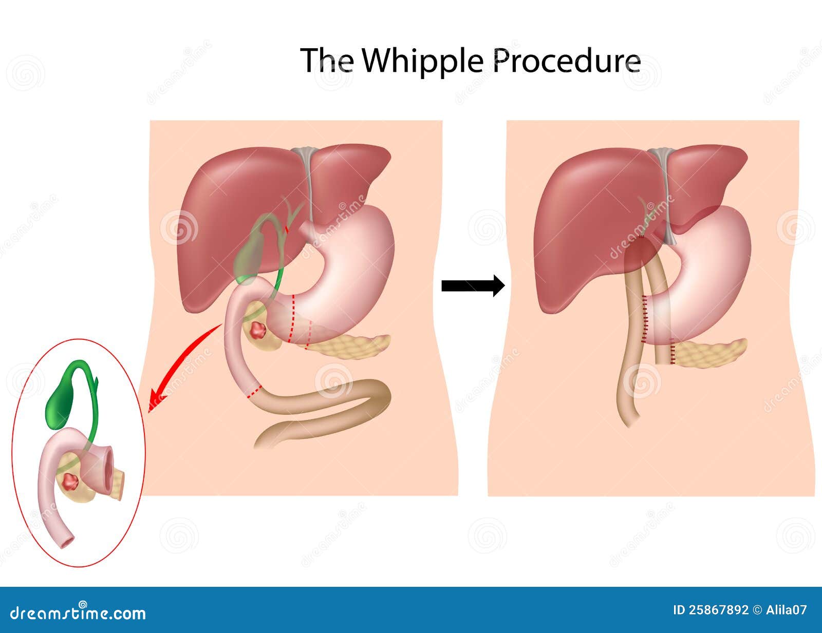 whipple procedure diagram