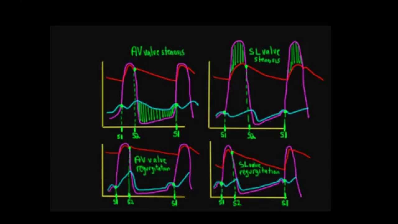 wiggers diagram aortic regurgitation