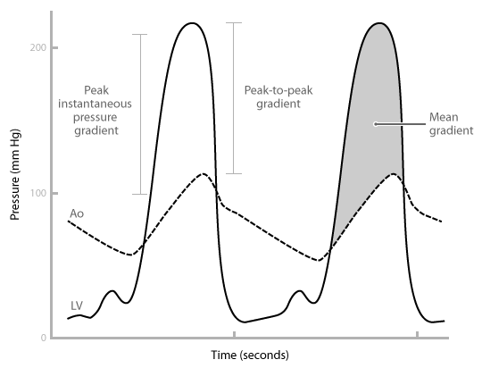 wiggers diagram aortic stenosis