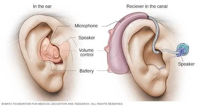 hearing aid parts diagram