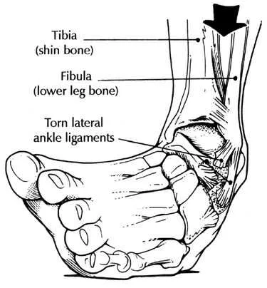 diagram of a sprained ankle