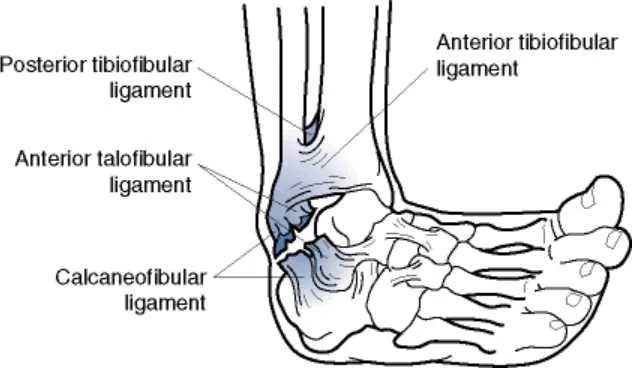 diagram of a sprained ankle